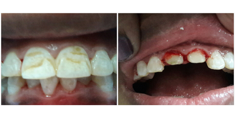 Teeth Whitening Procedures in Mukherjee Nagar